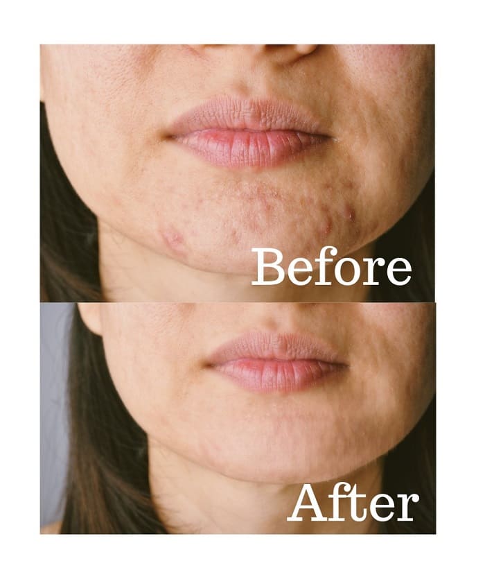 ミレム　ビュートリックの使用前使用後④